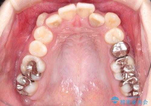 八重歯が気になる　ワイヤーによる抜歯矯正できれいな歯並びへの治療前
