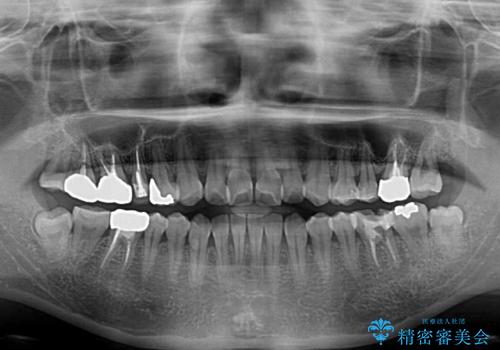 気になる前歯をインビザライン・ライトで　矯正治療後には銀歯をセラミックにの治療前