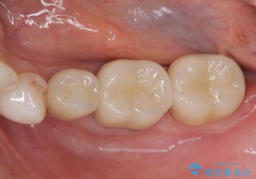 歯ぐきの腫れを改善する歯周外科手術を伴うセラミック治療の治療後