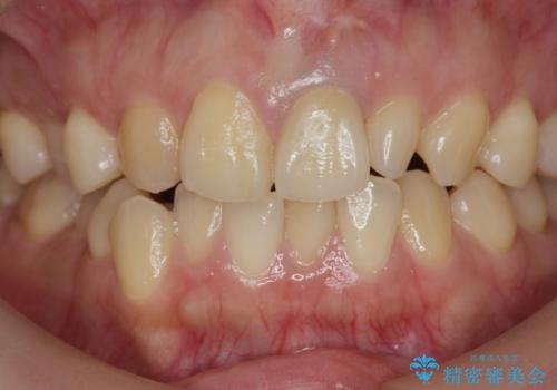 [ 前歯セラミック治療 ]白く不自然な前歯をきれいにしたいの治療後