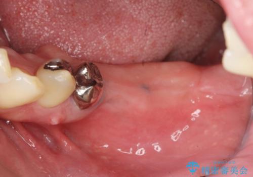 臼歯部インプラント・再補綴の治療前