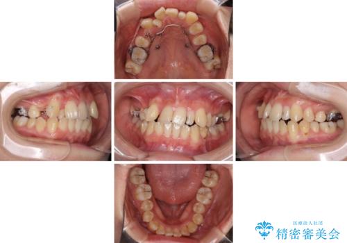 八重歯の抜歯矯正　補助装置を用いたインビザライン矯正の治療中