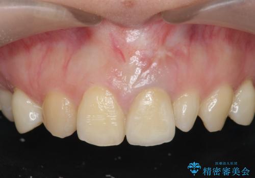 [ 前歯セラミック治療 ]白く不自然な前歯をきれいにしたいの症例 治療後