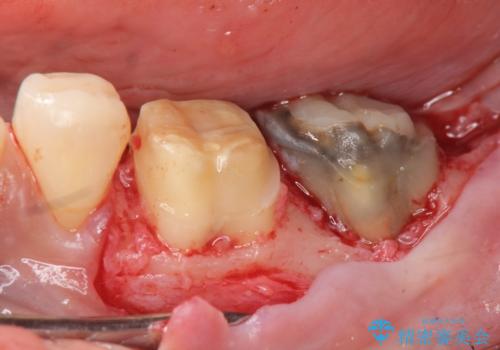 歯周外科で達成する、安定したクラウン周囲の歯肉環境の治療中