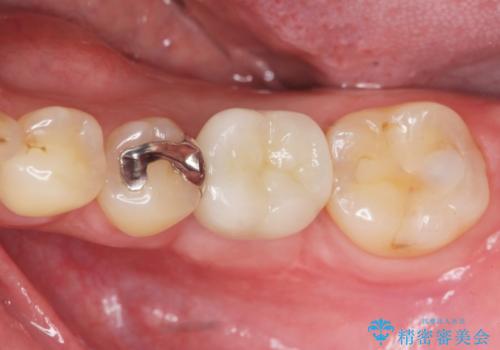 銀歯下の虫歯再発　インプラントによる機能回復の治療後