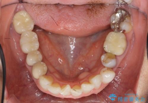 [ セラミック・インプラント全顎治療 ]  長年悩まされている歯の治療にケリをつけたいの治療前