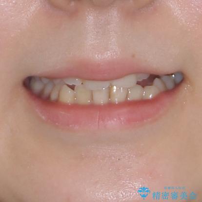 顕著な八重歯をインビザラインで治せるところまで改善の治療前（顔貌）