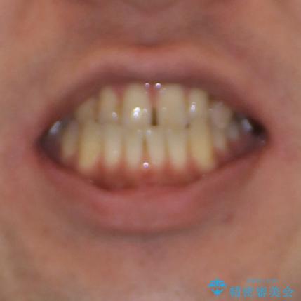 前歯の反対咬合をワイヤー矯正で改善して噛みやすくの治療前（顔貌）