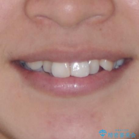 目立たないハーフリンガル矯正　抜歯矯正で口元を改善の治療前（顔貌）