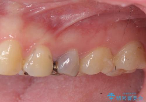 放置された虫歯　小矯正+歯周外科による保存処置の症例 治療前