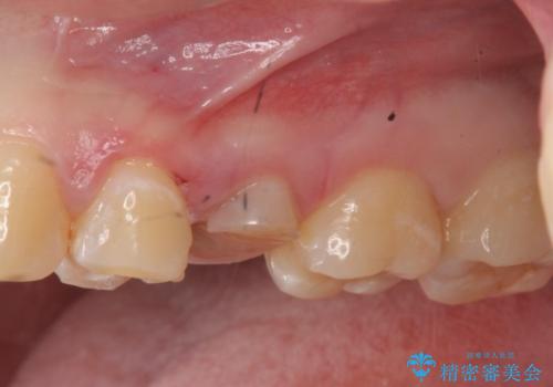 放置された虫歯　小矯正+歯周外科による保存処置の治療中