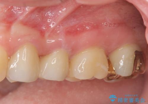 放置された虫歯　小矯正+歯周外科による保存処置の治療後