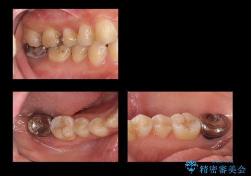奥歯の歯ぐきからウミが出る　抜歯してインプラントへの症例 治療前