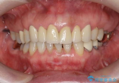 [ セラミック治療 ]前歯の見た目を改善したいの治療後