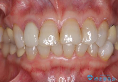 [ セラミック・インプラント全顎治療 ]  長年悩まされている歯の治療にケリをつけたいの症例 治療前