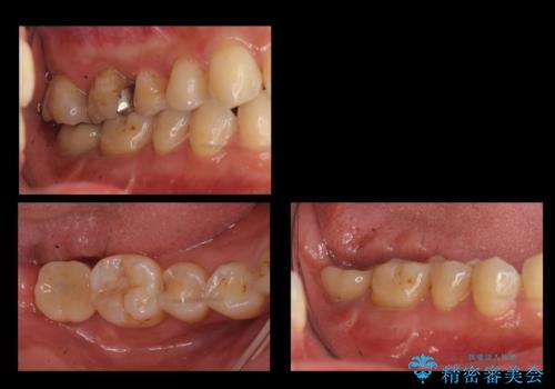 奥歯の歯ぐきからウミが出る　抜歯してインプラントへの症例 治療後