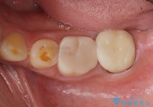 歯周外科で達成する、安定したクラウン周囲の歯肉環境の治療前
