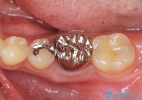 銀歯下の虫歯再発　インプラントによる機能回復の治療前