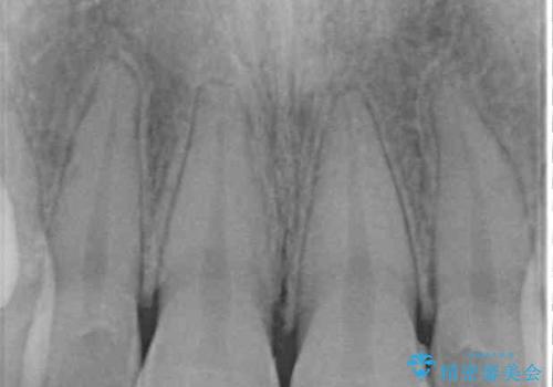前歯の形を変えたい　前歯のラミネートベニア治療の治療後