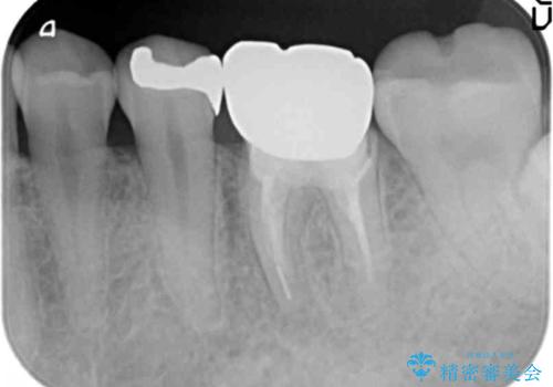 銀歯下の虫歯再発　インプラントによる機能回復の治療前