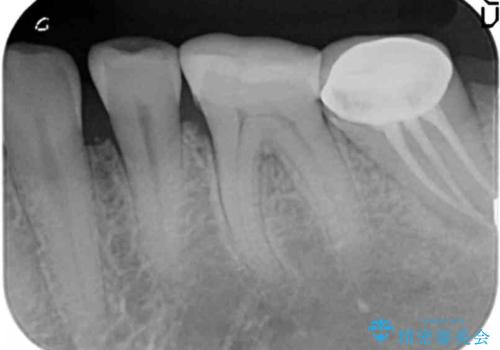 歯周外科で達成する、安定したクラウン周囲の歯肉環境の治療前