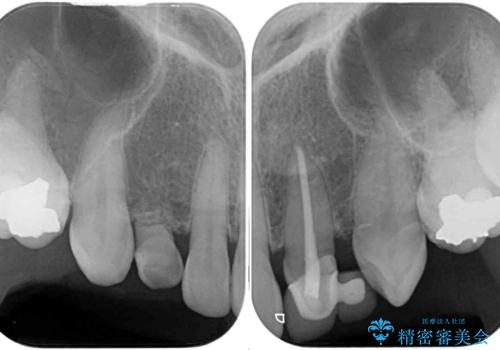欠損の多い歯列　部分矯正とセラミックブリッジで自然な見た目にの治療前