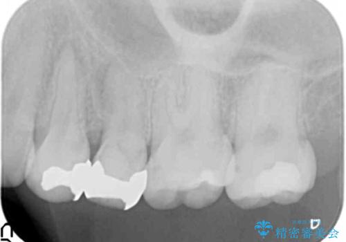放置された虫歯　小矯正+歯周外科による保存処置の治療前