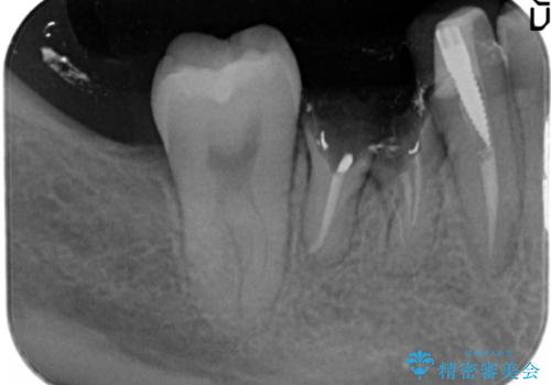 奥歯のインプラントの治療前