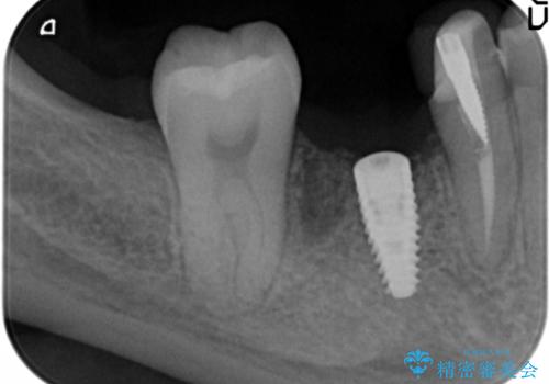 奥歯のインプラントの治療中
