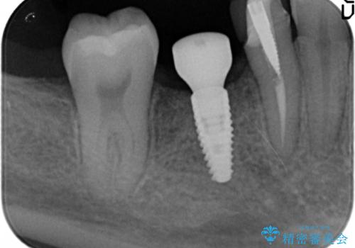 奥歯のインプラントの治療中