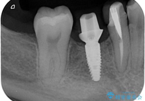 奥歯のインプラントの治療後