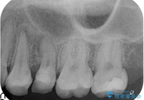放置された虫歯　小矯正+歯周外科による保存処置の治療中