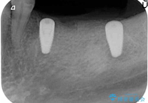奥歯のインプラント　大人になって残っていた乳歯がダメになったの治療中