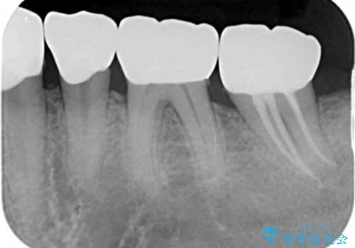 歯周外科で達成する、安定したクラウン周囲の歯肉環境の治療後
