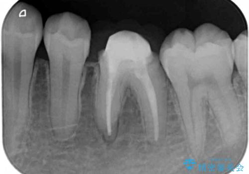 奥歯の被せものが汚れやすい　仮歯のままの歯をセラミッククラウンにの治療前