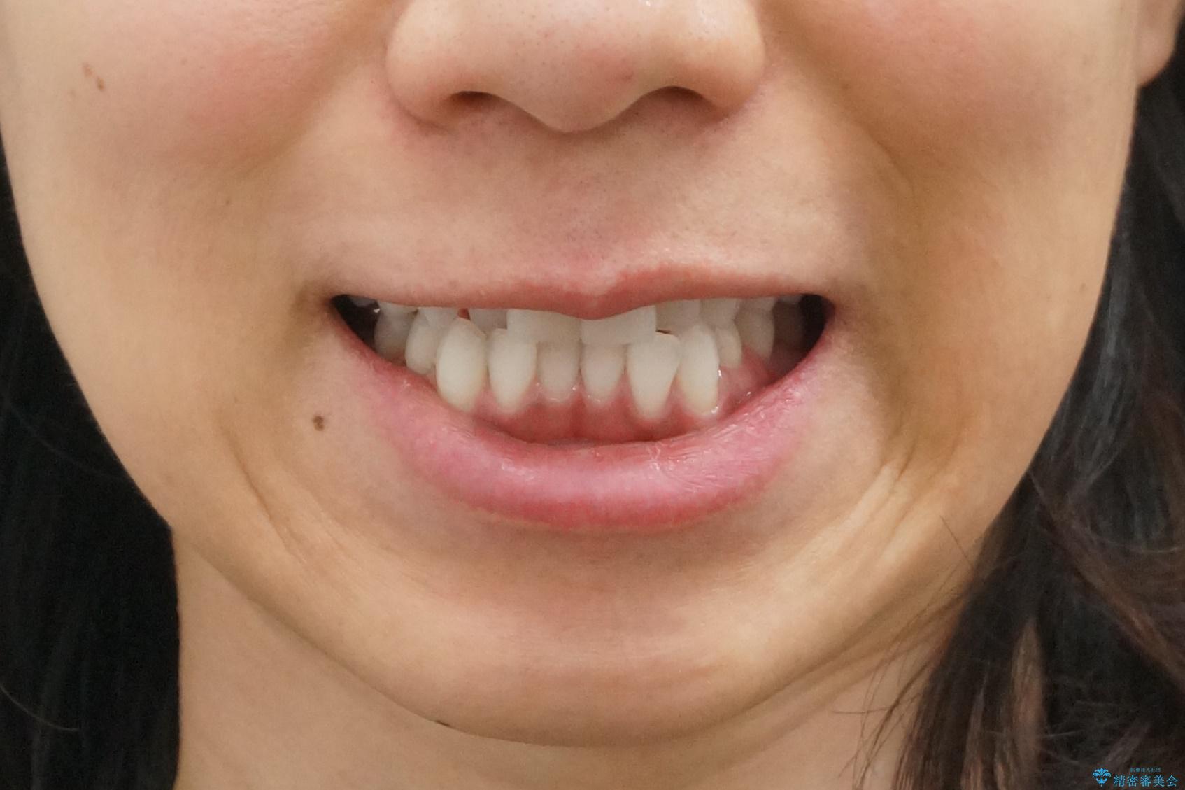 30代女性 前歯のがたつきの治療前（顔貌）