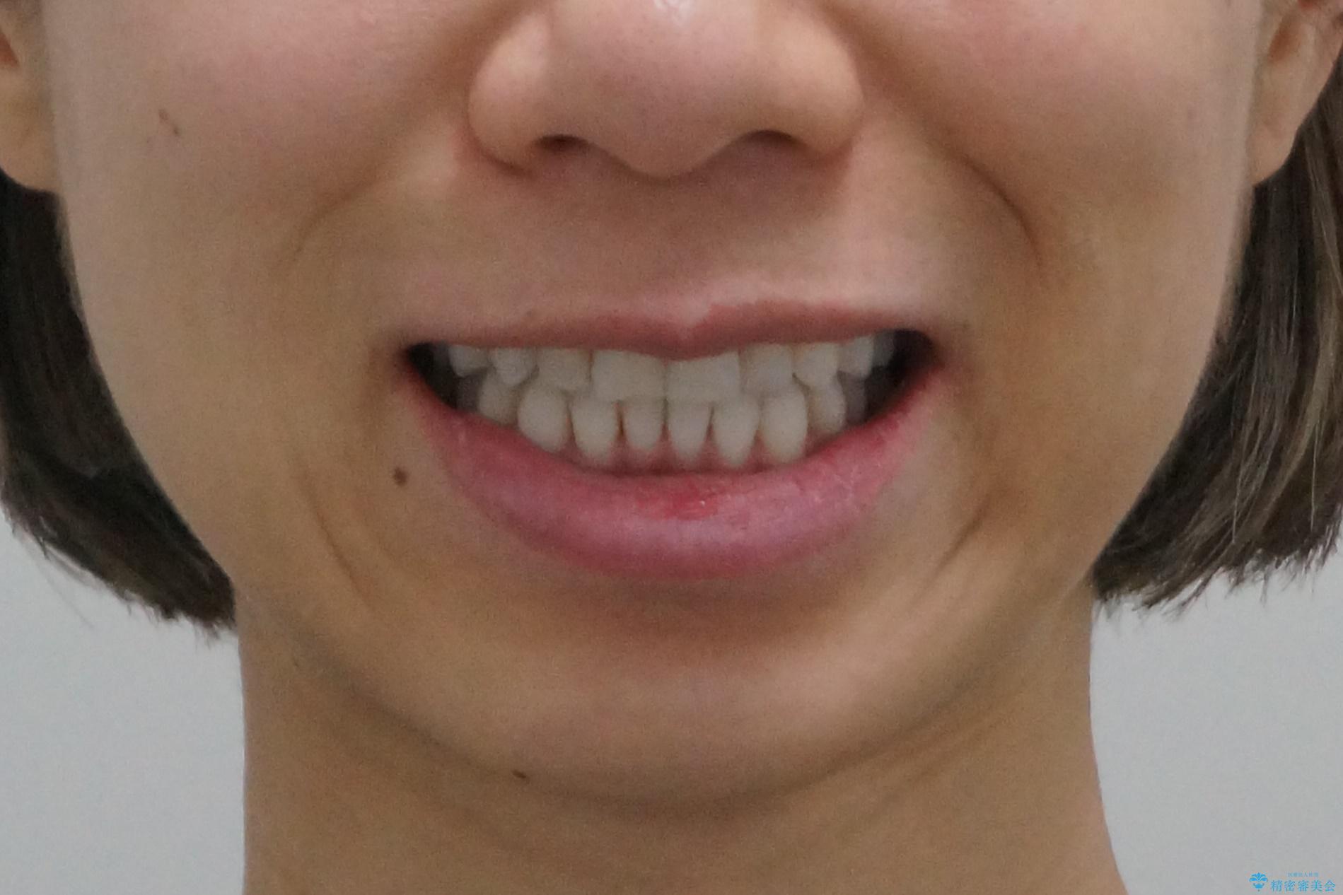30代女性 前歯のがたつきの治療後（顔貌）
