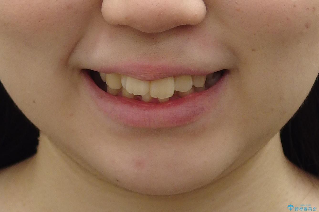 20代女性　前から5番目の歯を抜歯の治療前（顔貌）