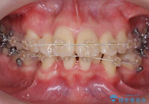 20代女性　前から5番目の歯を抜歯の治療中
