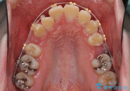 20代女性　前から5番目の歯を抜歯の治療中