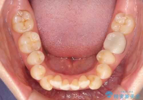 抜歯矯正で閉じにくかった口を閉じやすく改善の治療前