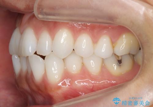 30代女性 前歯のがたつきの治療前