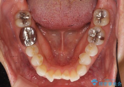 30代女性 前歯のがたつきの治療前