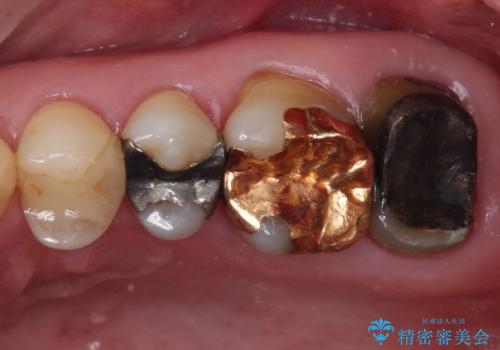 奥歯が外れた　ゴールドクラウンによる補綴治療の症例 治療前