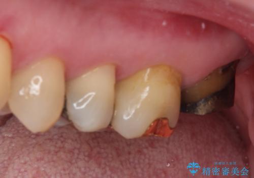 奥歯が外れた　ゴールドクラウンによる補綴治療の治療前