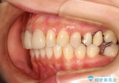 歯並びの改善とインプラントでのかみ合わせの回復　インプラント・セラミック・矯正全顎治療の治療中