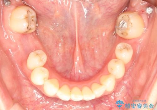 歯並びの改善とインプラントでのかみ合わせの回復　インプラント・セラミック・矯正全顎治療の治療中