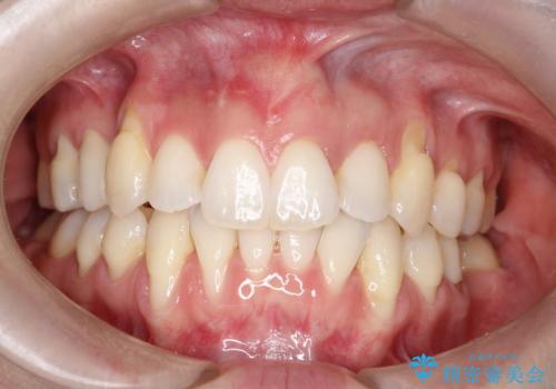 目立つ部位の歯茎がさがってきた　歯茎の移植で元の位置まで回復の症例 治療後
