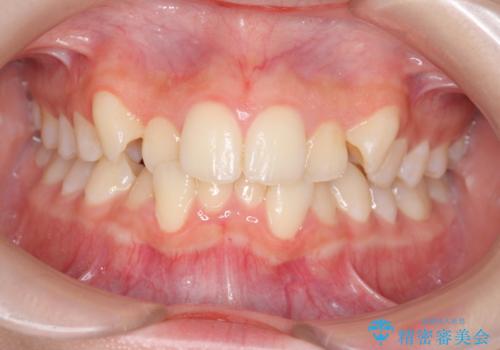[ 前歯のガタつきを治す ]マウスピース矯正インビザラインの症例 治療前