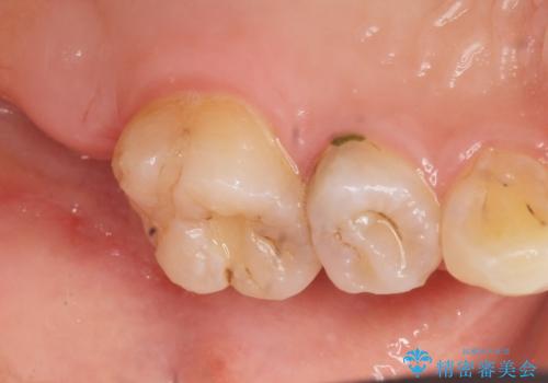 フロスを通すと臭い　歯と歯の間の虫歯　セラミックインレー　30代女性の治療前